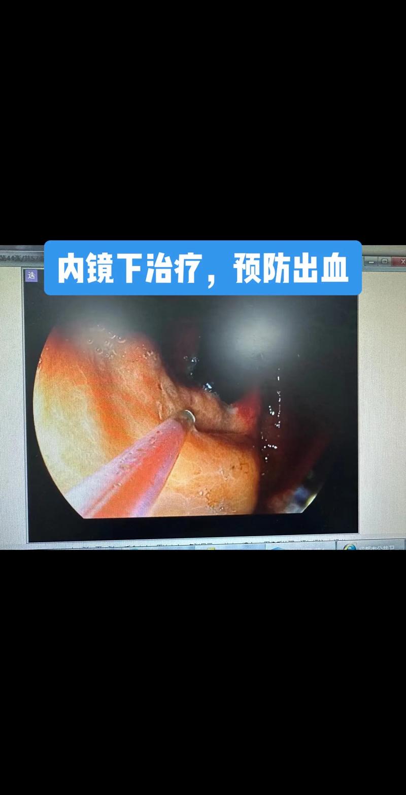 肝硬化與胃鏡檢查 守護(hù)消化道健康的關(guān)鍵一步